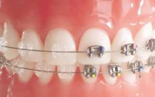 Сколько стоят брекеты на зубы — цены на металлические, керамические, сапфировые и лингвальные системы