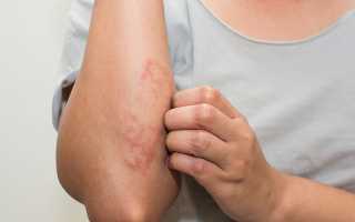 Методы лечения дерматита в домашних условиях