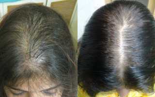 Выпадение волос на голове у женщин