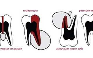 Воспаление корня зуба: в чем опасность заболевания и тактика его лечения