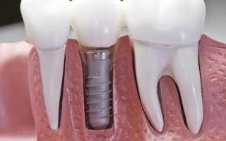 Зубные импланты: восстановление функции зубного ряда и комфорт улыбки