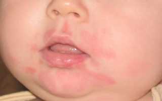 Что такое лямблии у детей: симптомы, признаки и лечение