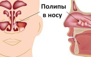 Что такое полипы в носу: симптомы и лечение