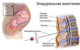 Эпидуральная анестезия при родах: зачем и как проводится процедура