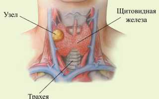 Что такое узлы в щитовидной железе: чем опасны и как их лечат