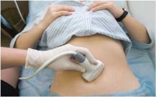 Беременность с внутриматочной спиралью: причины и последствия